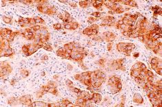 Ductal Carcinoma, fot. unsplash / National Cancer Institute Ductal Carcinoma, fot. unsplash / National Cancer Institute